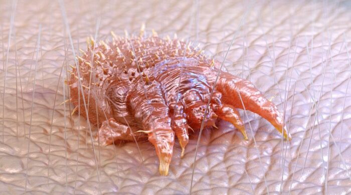 স্কাবিস সংক্রমিত ত্বক চুলকানি