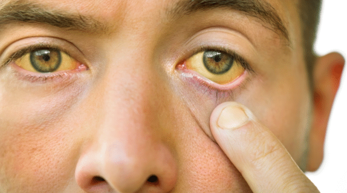 জন্ডিসে আক্রান্ত ব্যক্তির চোখ হলুদ হয়ে যাওয়ার লক্ষণ